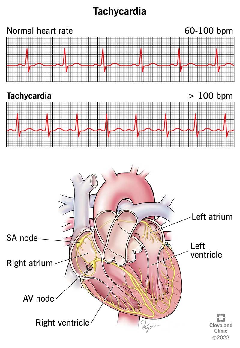 22108-tachycardia-illustration.jpg