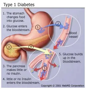 42943_type1diabetes.webp