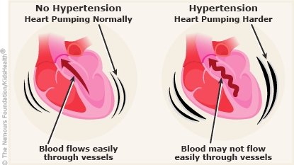 hypertension_a_enIL.jpg